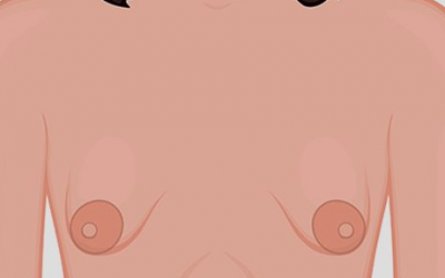 Do I have tubular breasts?