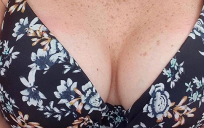 What is the difference between Breast Augmentation & Re-Augmentation