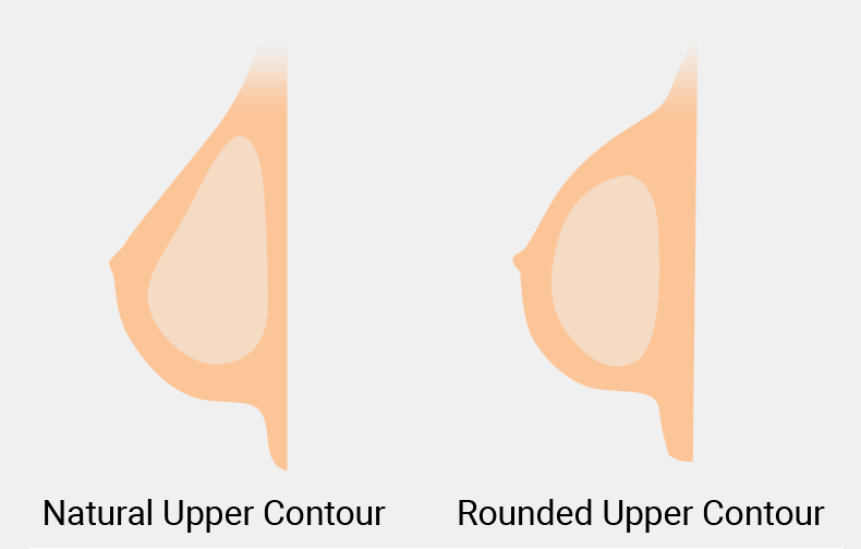 Two Popular Breast Implant Shapes: Round and Teardrop - Who Are