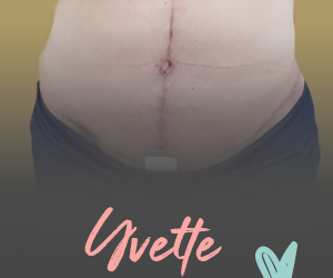Tummy Tucks and Weight Loss.