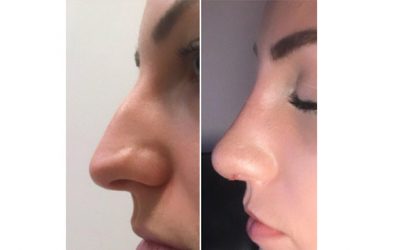 Rhinoplasty Can Be Life Changing.