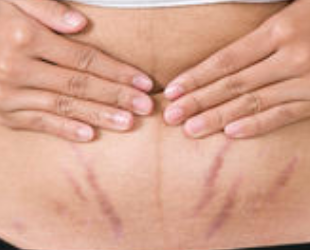 Tummy Tuck Surgery After Pregnancy.