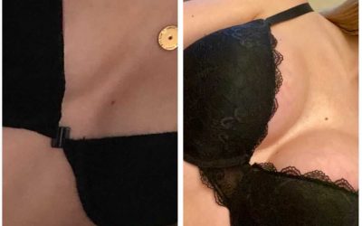 Breast Surgery Before and After Images.