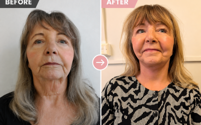 How Facelifts Became a Badge of Honour – And Why More Women Are Embracing Them